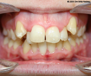 Marie-Hélène Cyr - Central intraoral view - Before orthodontic treatments and orthognathic surgeries (November 24, 2005)